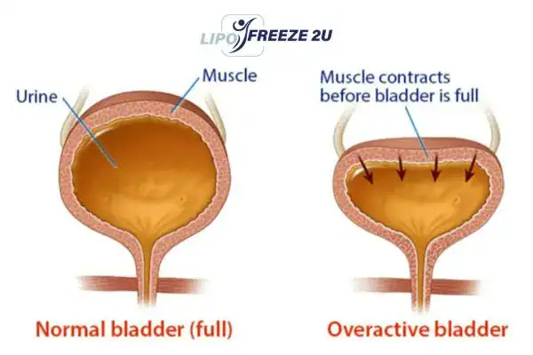 diagram of overactive bladder treatment Northamptonshire
