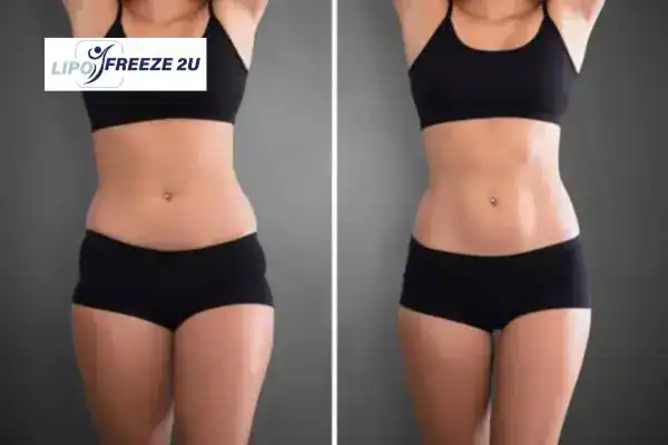 How Can LIPO FREEZE 2U Support Your Post-Pregnancy Body Recovery Northamptonshire?