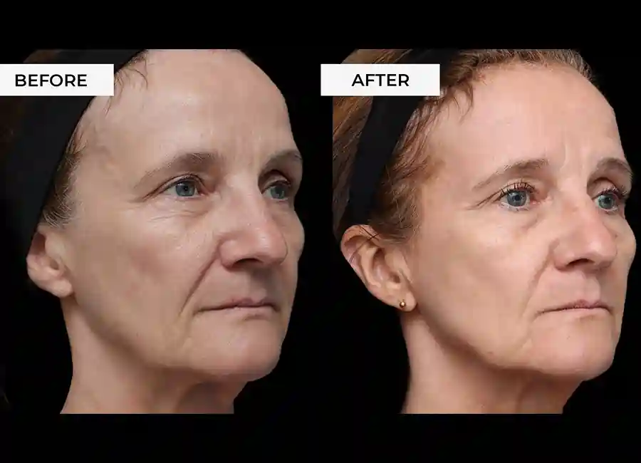 How Many RF Microneedling Sessions Will You Need to See a Difference Northamptonshire?