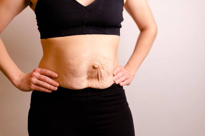 Is Surgery Really the Only Way to Repair Diastasis Recti Northamptonshire?