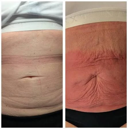 How Does RF Microneedling Improve Crepey, Thin and Uneven Skin Texture Northamptonshire?