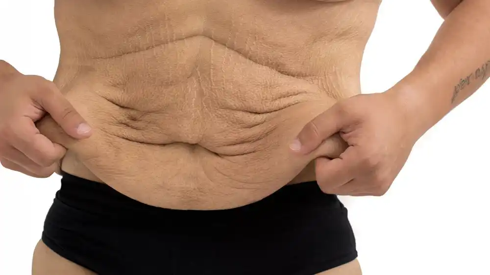 Why Does Weight Loss Medication Leave Some People With Loose or Sagging Skin Northamptonshire?